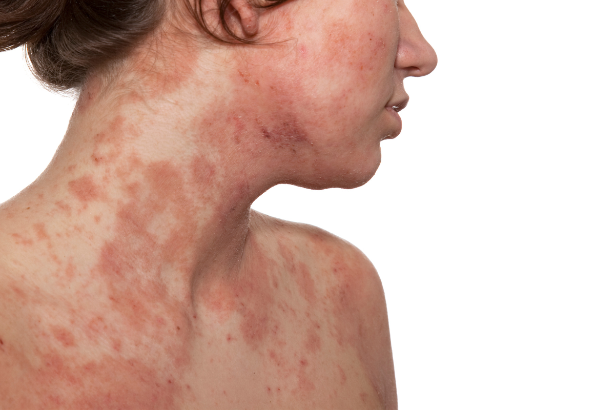 Kollagen och eksem (atopisk dermatit)