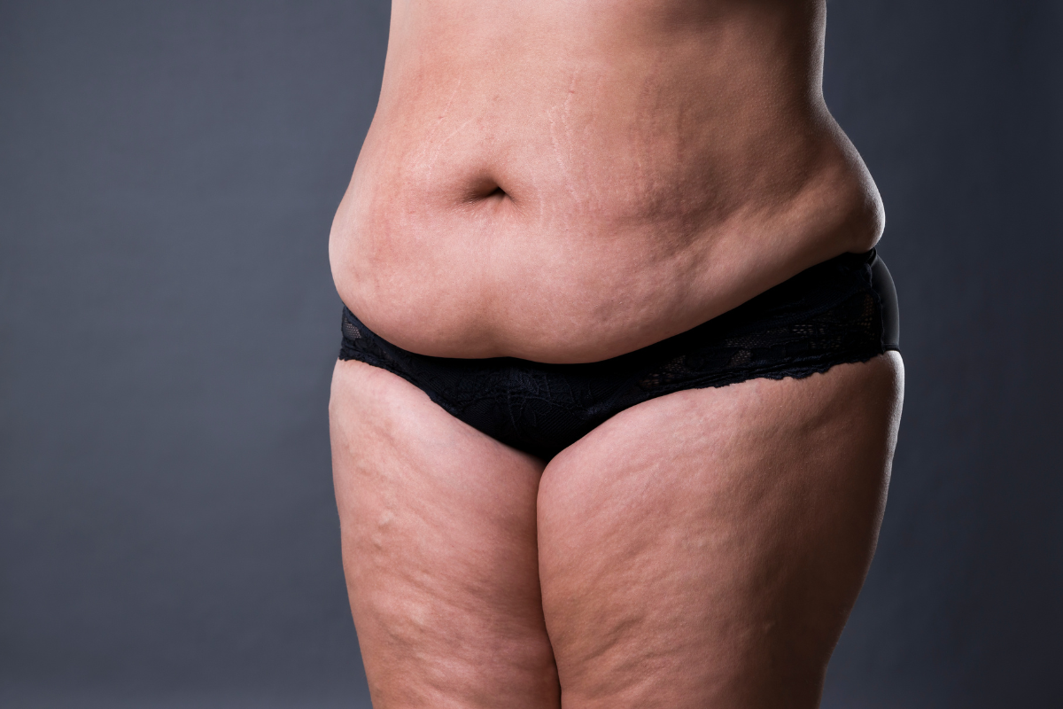 kollagen celluliter collagen cellulite celloptimum