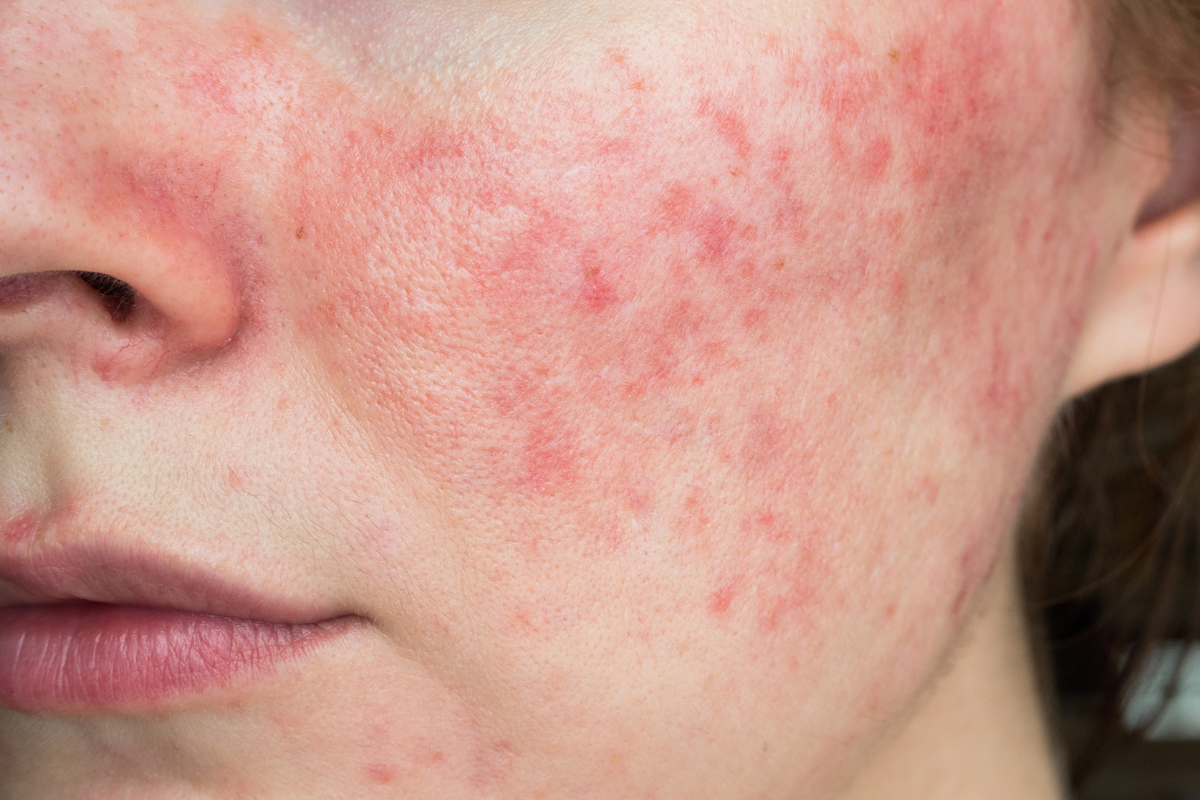 rosacea kollagen collagen celloptimum