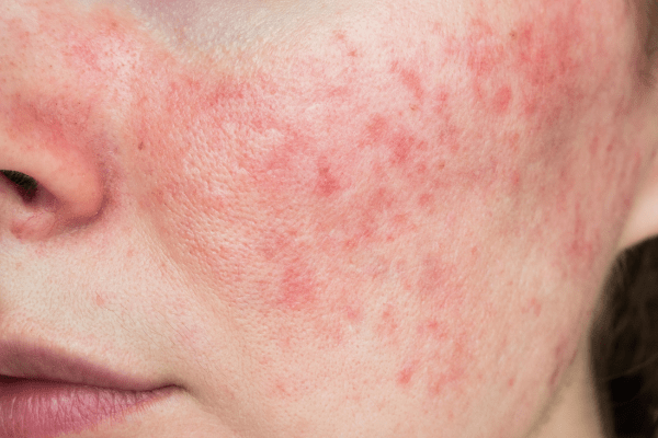 Kollagen och rosacea